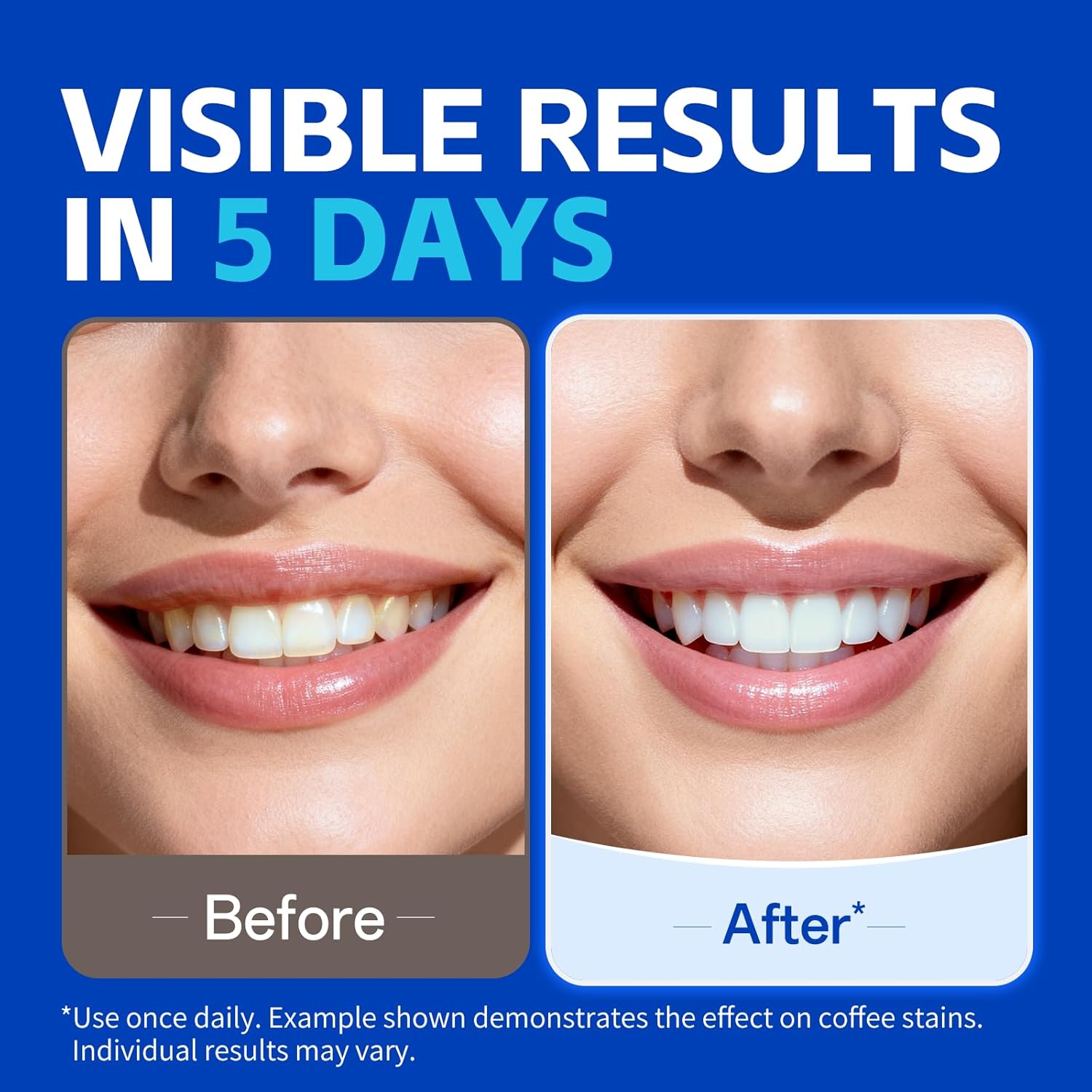 7 أزواج من شرائط تبييض الأسنان - مراجعة Teeth Whitening Street وسعره